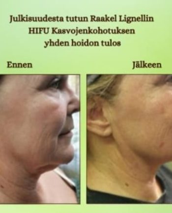 Kasvojenkohotus muutoskuva Raakel Lignell Hyvän Olon Aitta kosmetologi Hämeenlinna