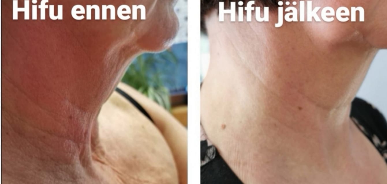 Hifu kasvojenkohotus Hyvän Olon Aitta kosmetlogi Hämeenlinna
