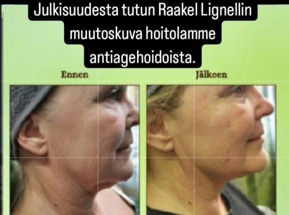 Antiagehoidot Raakel Lignellille Hyvän Olon Aitta kosmetologi Hämeenlinna
